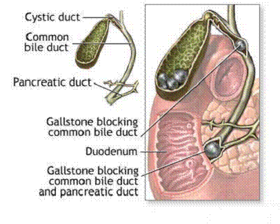 Gall_Stone_Disease_clip_image002.gif