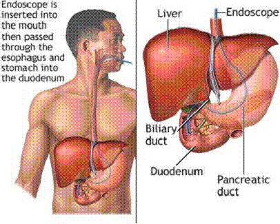 Gall_Stone_Disease_clip_image002_0000.gif